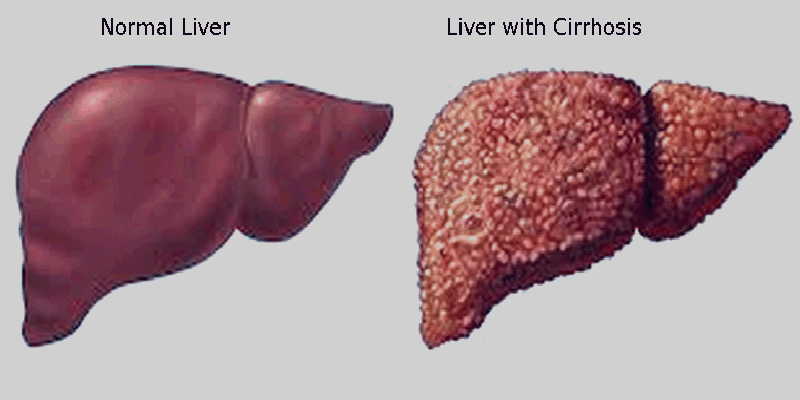Hepatitis B hits epidemic proportions with more than 3.5m