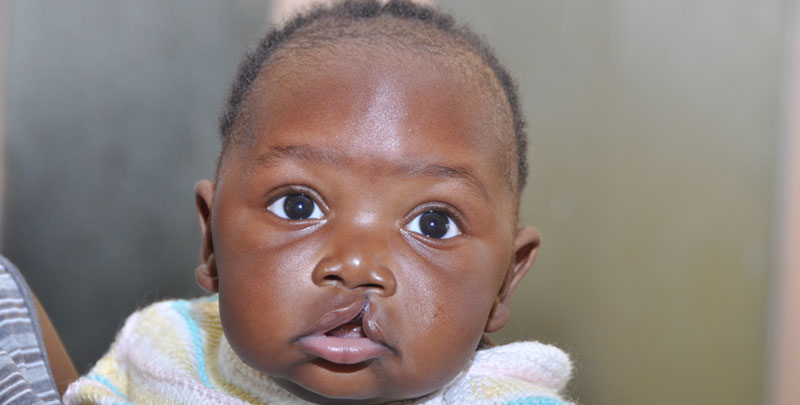 Cleft