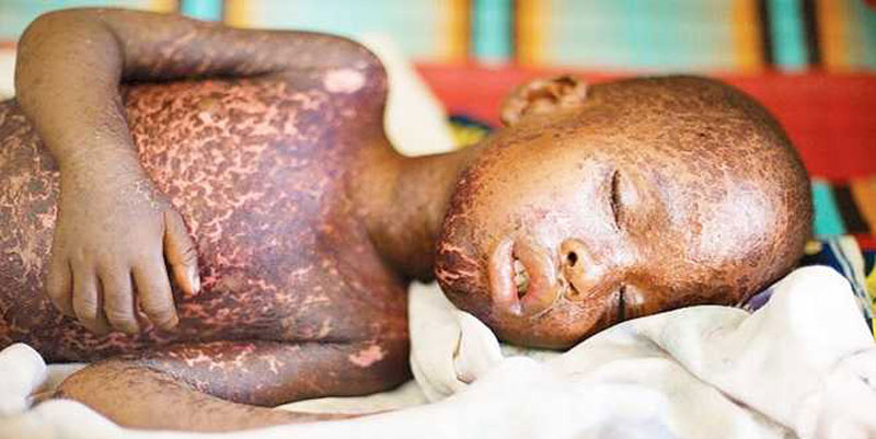 Measles