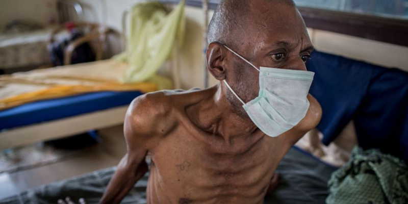 TB burden remains a dangerous but silent disease in Uganda